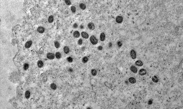 RN registra três novos casos de Mpox; pacientes estão em isolamento domiciliar